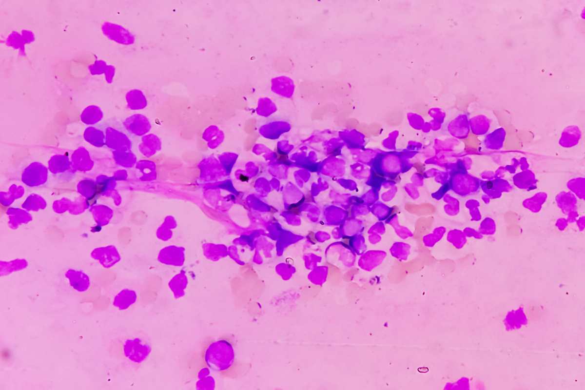 Leucemia mieloide: i segreti della diagnosi precoce