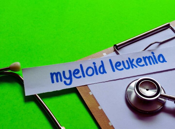 Leucemia mieloide: i segreti della diagnosi precoce